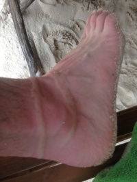 An image of the jellyfish venom around my ankle
