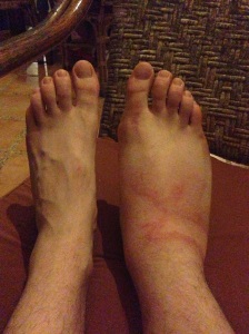 Swelling in my foot that night